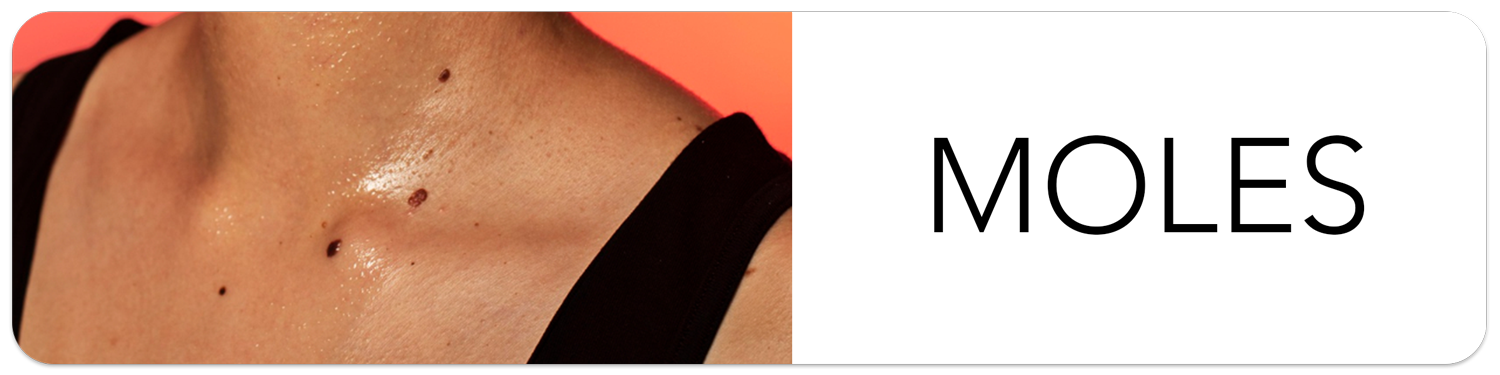 slide5 seborrheic derma