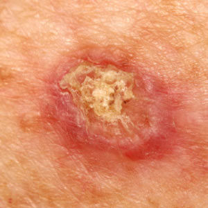 spots Squamous Cell Carcinoma